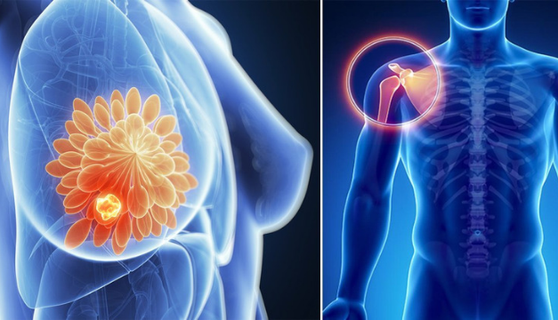 ¿Cuál es la diferencia entre un sarcoma y un carcinoma?