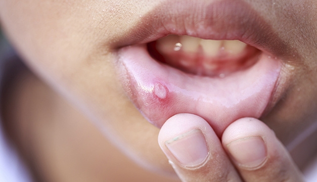5 Remedios para curar llagas de la boca