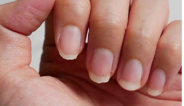 Tus uñas pueden estarte advirtiendo enfermedades
