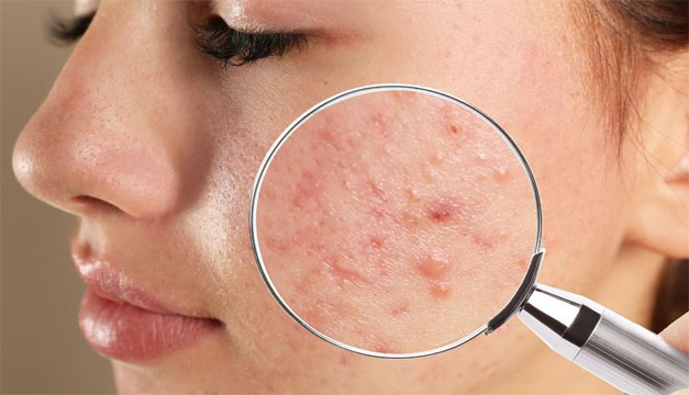 ¿Tienes más de 35 años y sufres de acné? Presta atención
